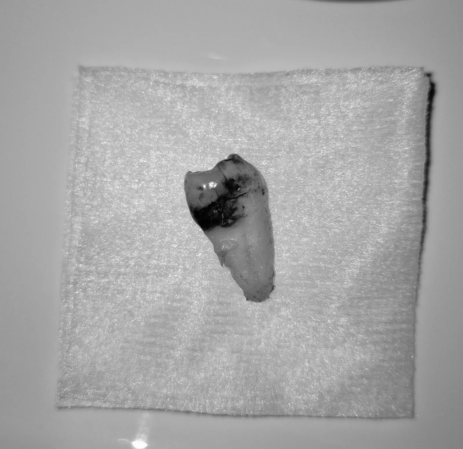 Extracción dental